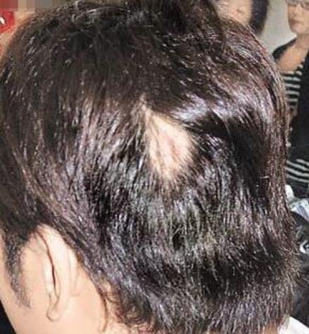 斑秃能预防吗