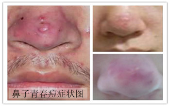 鼻头长粉刺的原因 鼻头长粉刺的原因