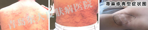 荨麻疹图片 荨麻疹图片