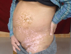 肚子上长白斑是白癜风吗? 肚子上长白斑是白癜风吗?