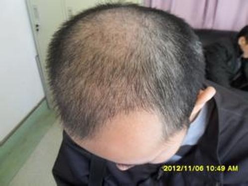 雄性激素与脂溢性脱发的关系